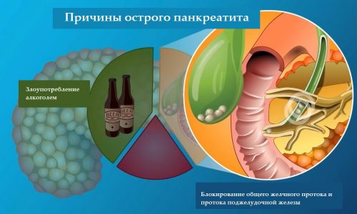 Панкреатит бывает разной этиологии