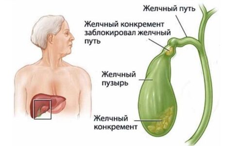 В большинстве случаев холецистит развивается на фоне желчнокаменной болезни
