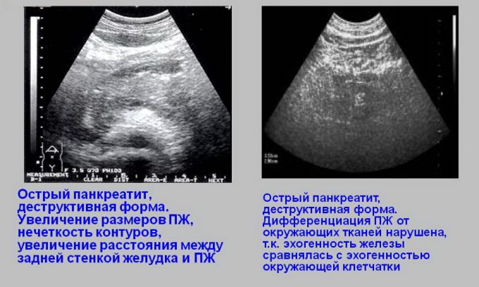 Подтвердить диагноз позволяет УЗИ