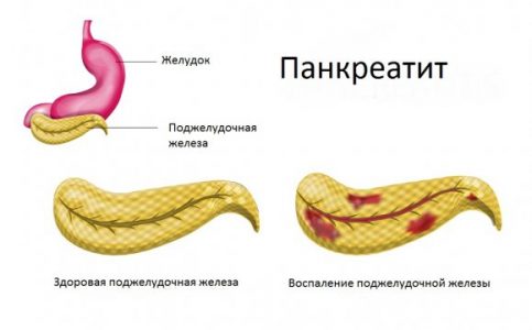 Важно обратить внимание врача на частичное увеличение размера железы пациента, у которого не было ранее жалоб на характерные для панкреатита боли