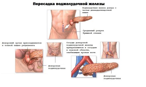 Схема пересадки поджелудочной железы