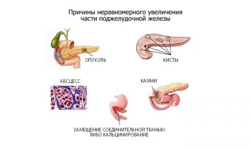 Локальное увеличение является более опасным, в отличие от общего изменения органа