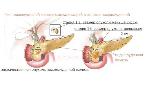 Пик заболеваемости раком головки поджелудочной железы наблюдается у людей в возрасте 70 лет, при этом мужчины болеют чаще женщин