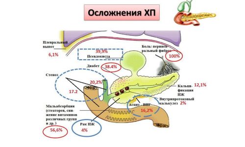 Острый вид панкреатита вызывает гибель живых клеток
