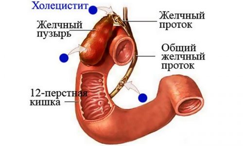 Схема холецистита