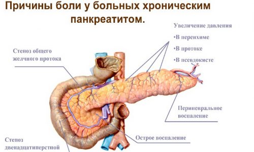 Схема панкреатита