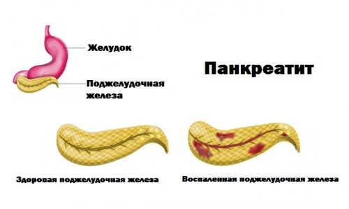 Схема панкреатита