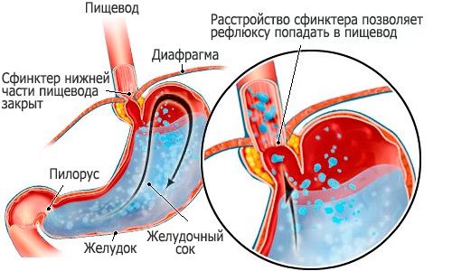 Причиной изжоги при панкреатите служит заброс в пищевод кислой части содержимого желудка