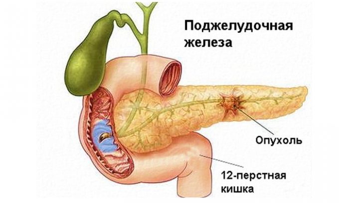 Наличие патологических клеток приводит к развитию доброкачественной или злокачественной опухоли.